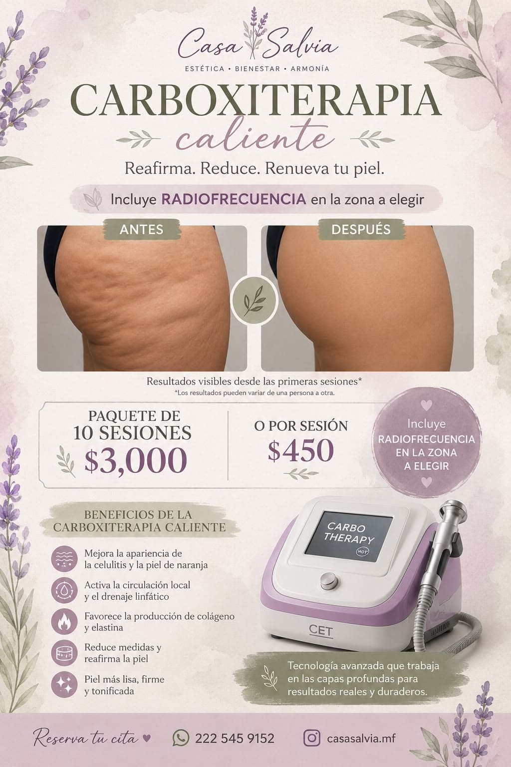 Carboxiterapia